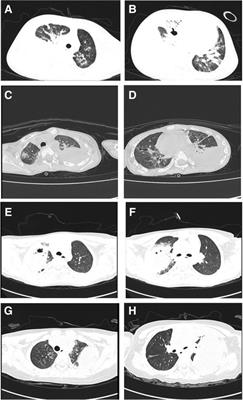 Pediatric pulmonary infection caused by oral obligate anaerobes: Case Series